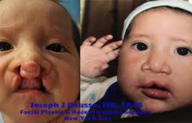 After a thorough examination through diagnostic testing and medications, the doctor will start preparing for the surgical procedure. Cleft Lip Surgery From A Plastic Surgeon New York Ny