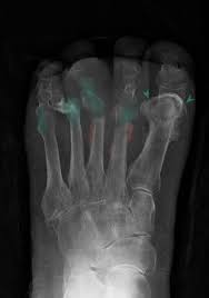 Image result for Osteomyelitis XRay