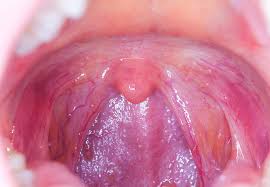 Throat cancer can cause pain or a burning sensation when chewing and swallowing food. Throat Cancer S Link To Oral Sex What You Should Know Health Essentials From Cleveland Clinic