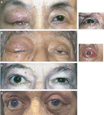 Orbital Inflammatory Disease A Diagnostic And Therapeutic Challenge Eye