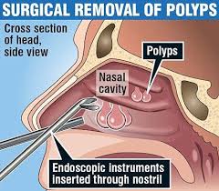 A person may require sinus surgery to treat a variety of issues. The 30 Minute Operation That Gave Me Back My Sense Of Smell Polyp Sinusitis Sinus Cavities