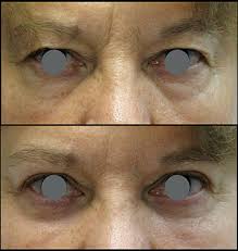 It is elevated from the preexisting defect, thus avoiding an additional forehead scar. Cataract Surgery The Oculoplastic Factor