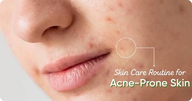 acne prone skin moisturizer