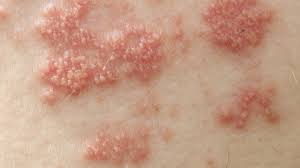 Maybe you would like to learn more about one of these? Shingles The Facts And Myths