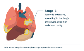 Angiogenesis makes new blood vessels that connect to the growing tumor and provide it with blood and nutrients. Stage 3 Mesothelioma Prognosis Treatment Symptoms