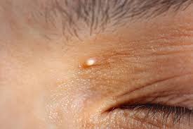 Image result for milium cyst on eyelid