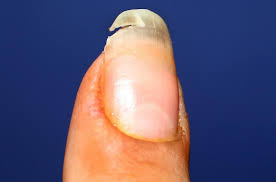 Nail Abnormalities Causes Symptoms And Pictures