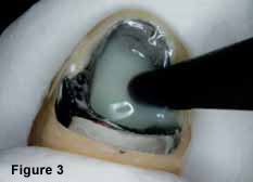 We did not find results for: Pulpdent Embrace Resin Cement Simple Predictable Crown Cementation Dentalcompare Top Products Best Practices