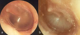 Secretory Otitis Media (Glue Ear) - Ρινολογική Ομάδα Αθηνών