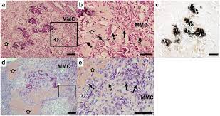Physicians often first detect mesothelioma late in the course of the disease, usually with a poor prognosis. A Subset Of Malignant Mesothelioma Tumors Retain Osteogenic Potential Scientific Reports