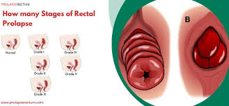 Image result for Rectal prolapse