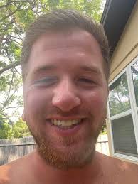 Image result for skin cancer on nose pimple