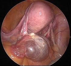 Occasionally they may produce bloating, lower abdominal pain, or lower back pain. Ovarian Cysts And Pelvic Masses Cigc