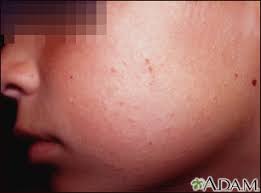 Image result for Keratosis pilaris
