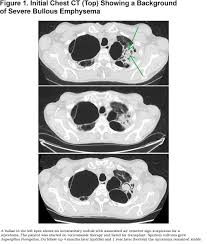 Diagnosing an infection caused by aspergillus mold can be difficult and aspergillus is common in the environment and is sometimes found in the saliva and sputum of. Bullous Emphysema With Mycetoma Journal Of Copd Foundation