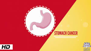 The cure for stomach cancer depends on how long the patient has been affected by the disease. Stomach Cancer Causes Signs And Symptoms Diagnosis And Treatment Youtube