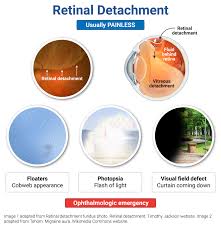 Image result for Retinal Detachment