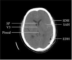 Brain Midline Shift Measurement And Its Automation A Review Of Techniques And Algorithms