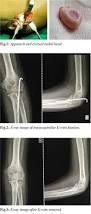Image result for Radial Head Dislocation