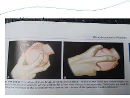 Image result for Manual Rotation in Occipitoposterior Presentation