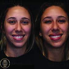 Botox For A Gummy Smile Botox Gummy Smile Botox Before And After