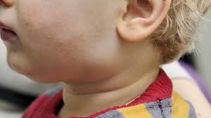 Image result for vyrážka u dětí
