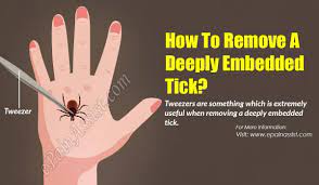 If you twist an embedded tick, you will most likely succeed in separating its body from its head, and the head will remain stuck in your skin where it can become infected. How To Remove A Deeply Embedded Tick