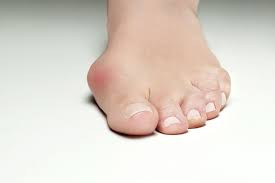 Hallux Valgus Das Schmerzhafte Problem Mit Dem Grossen Zeh Orthinform