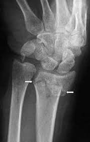 How long does a broken wrist take to heal. Recovering From Two Broken Wrists My Story Broken Wrist Heal Broken Bones Broken Bone