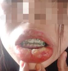 Laga perdananya datang saat melawan fenerbahce pada 2018, tetapi kini ia memimpikan santiago. Gara Gara Fake Braces Bibir Jadi Bernanah Dan Demam Panas Berlanjutan Selama 3 Hari Sungguh Menakutkan