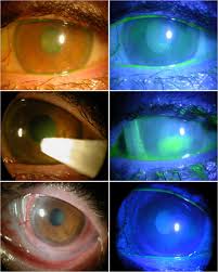 Herpes simplex virus (hsv) belongs to a small subfamily of viruses, herpesviridae. A Stepping Stone In Treating Dendritic Keratitis Sciencedirect