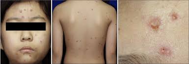 Erythematous pruritic vesicles, pustules and crusts