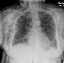 Pin On Chest Radiology