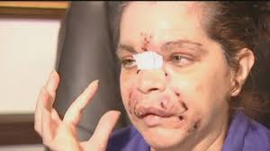 Suit claims medical spa gave woman severe facial infection