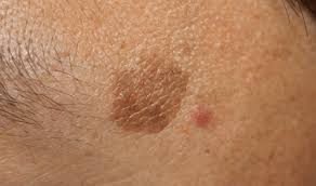 Of, țin minte și acum ora de dermatologie, îmi era foarte antipatică această materie. Tratament Pete Pigmentare Cu Laser Clinica Derma Expert By ElÅs