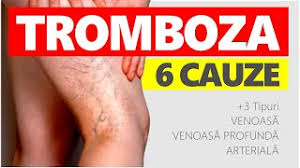 When a blood vessel (a vein or an artery) is injured, the body uses platelets (thrombocytes) and fibrin to form a blood clot to prevent blood loss. De Ce Facem Tromboza Venoasa Venoasa Profunda Arteriala Youtube