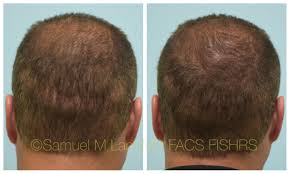 Pin On Scalp Micropigmentation