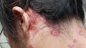 Image result for psoriasis