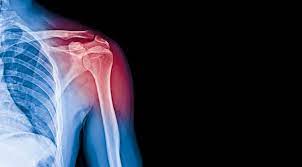 No comments on tendinitis : Penyakit Tendinitis Gejala Penyebab Pengobatan Klikdokter Com