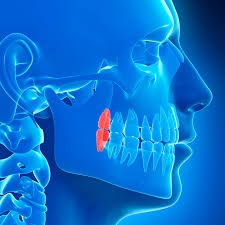 How much is it to remove impacted wisdom teeth. Warning Signs Of Impacted Wisdom Teeth Mdc Blog