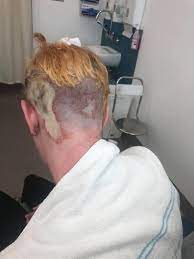 The skin can appear red or even black, with or without blisters. How To Heal My Scalp After Bleaching The Hair Twice Quora