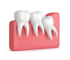 The average insurance cover about $1,500 towards the cost of wisdom teeth removal. What Are The Signs You Need Wisdom Teeth Removal Mas Ood Cajee Dds Mph