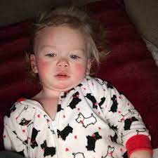 Tot Allergic To Water Breaks Out In Burning Rash From Own Tears And Is Now Being Taught Not To Cry Storytrender
