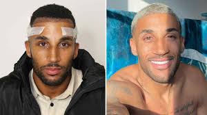 Afro Hair Transplant Before and After Results