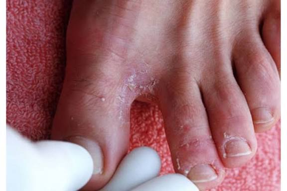 Thuốc điều trị nước ăn chân mùa mưa bão