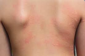 Skin allergy medicines in homeopathy. How To Cure Hives Naturally