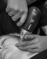 Pixel8-RF Vs SkinPen | BloGo Salon + MedSpa