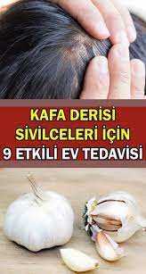 Kafa Derisinde Cikan Sivilceler Nasil Tedavi Edilir Evde Nasil Yapilir Dogal Cilt Bakimi Dogal Guzellik Ipuclari Dogal Saglik