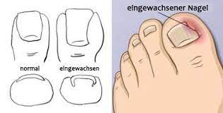 eingewachsene nagel was kann ich tun besser gesund leben eingewachsener nagel zehennagel eingewachsener zehennagel behandlung