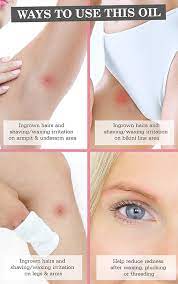 Ingrown hairs typically occur in teenagers and adults. Fur Ingrown Hair Concentrate Mitt Beauty And The Boutique